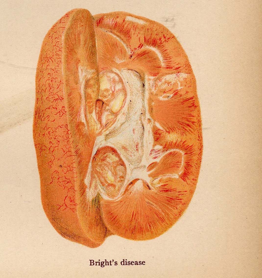 Liver Complaint Bright's Kidney Disease Human Anatomy 1908 Vintage Medical Lithograph Chart
