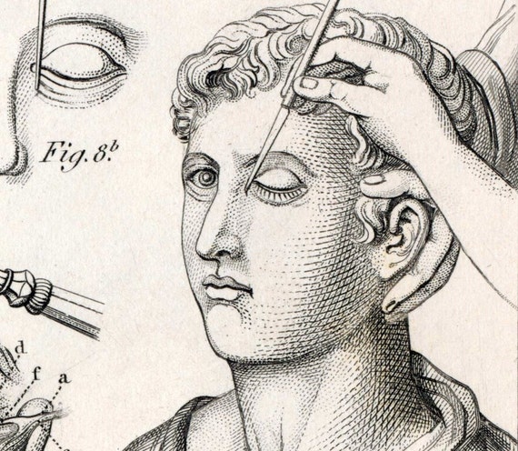 1851 Antique Steel Engraving of Ancient Medical by bananastrudel