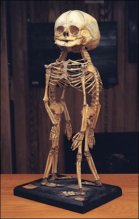 Conjoined Twins Siamese Fetal Skeletons, made to order.