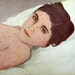 Chicken Pox - Medical Color Illustration of Sick Child , Rare 1916 Antique Color Plate