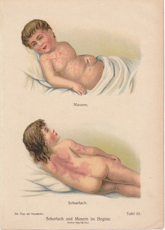 Scarlet Fever In Pregnant Women 72