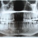 X ray of the jaws of a victim of the Black Death in Medieval London 4