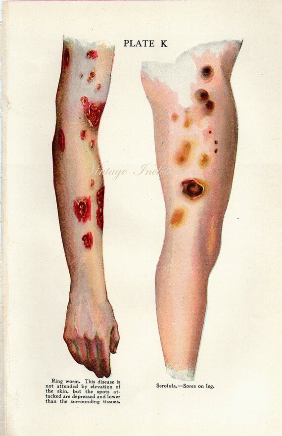 1911 Human Anatomy Print SCROFULA and RING WORM bookplate