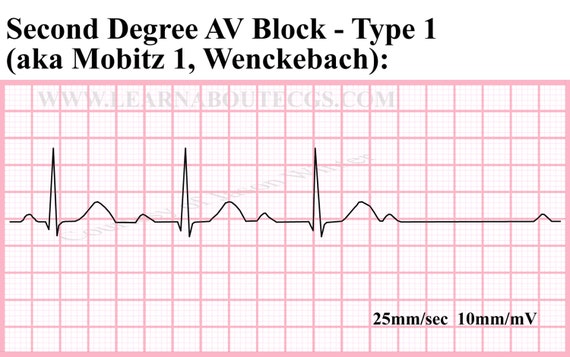 Items Similar To Second Degree AV Block Type 1 ECG Strip On Etsy