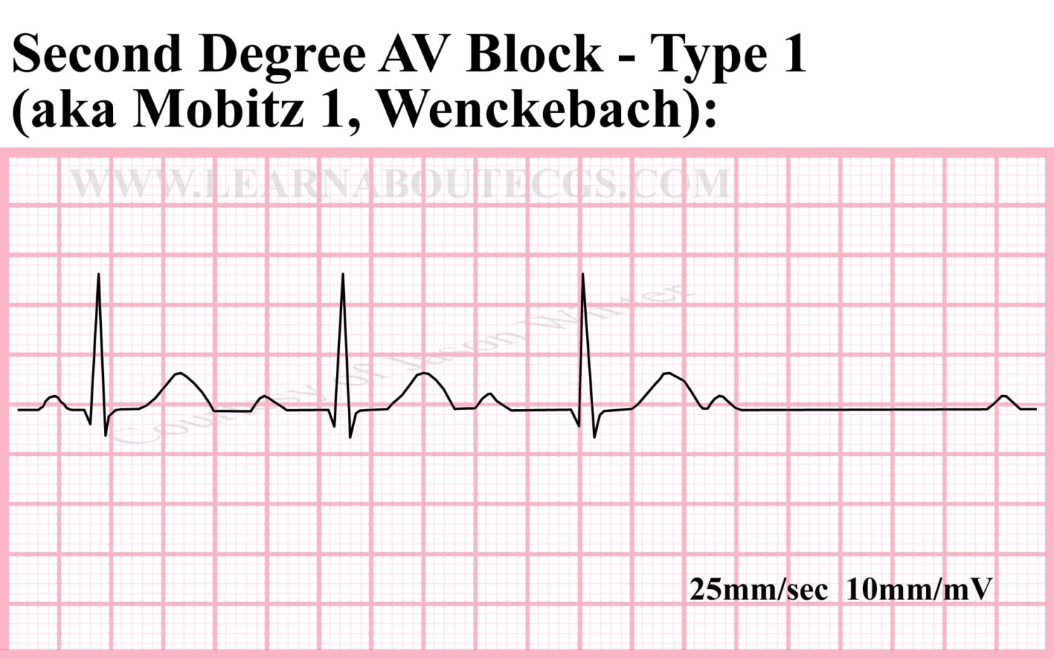 conduction-blocks-at-the-av-node-av-blocks-with-examples-manual