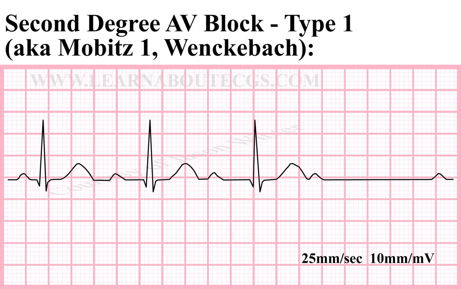  Second Degree AV Block Type 1 ECG Strip By ELECTROCARDIOLOGY