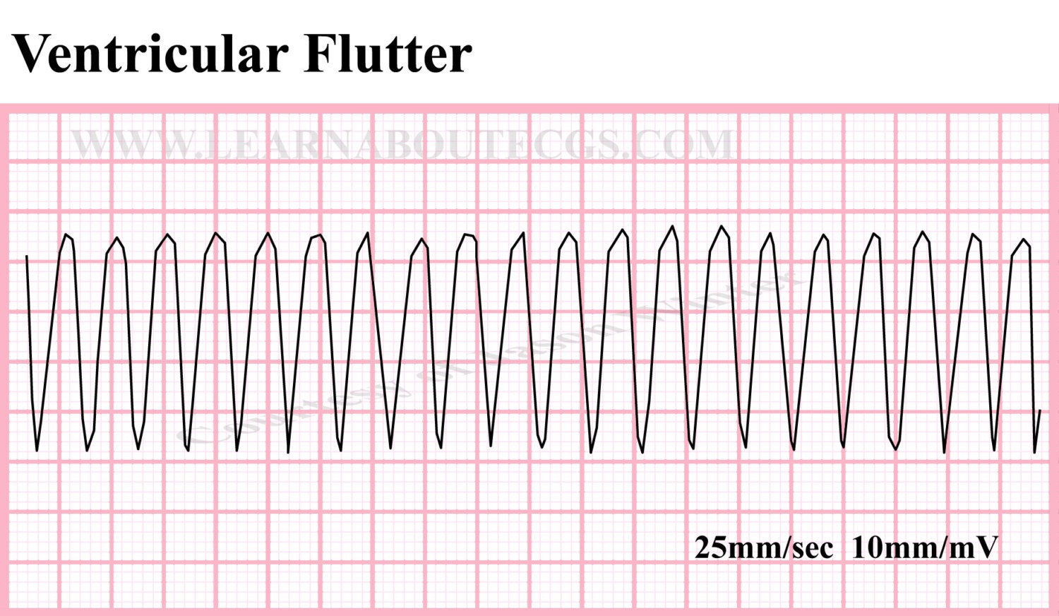 ventricular-flutter