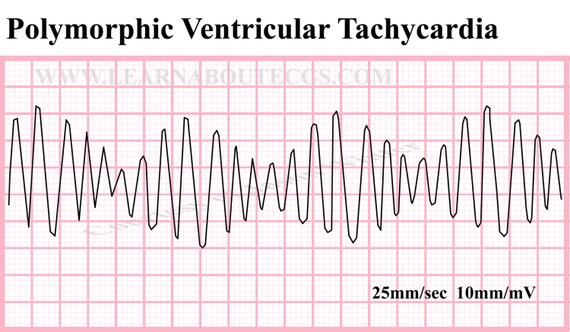 Items similar to Polymorphic Ventricular Tachycardia on Etsy