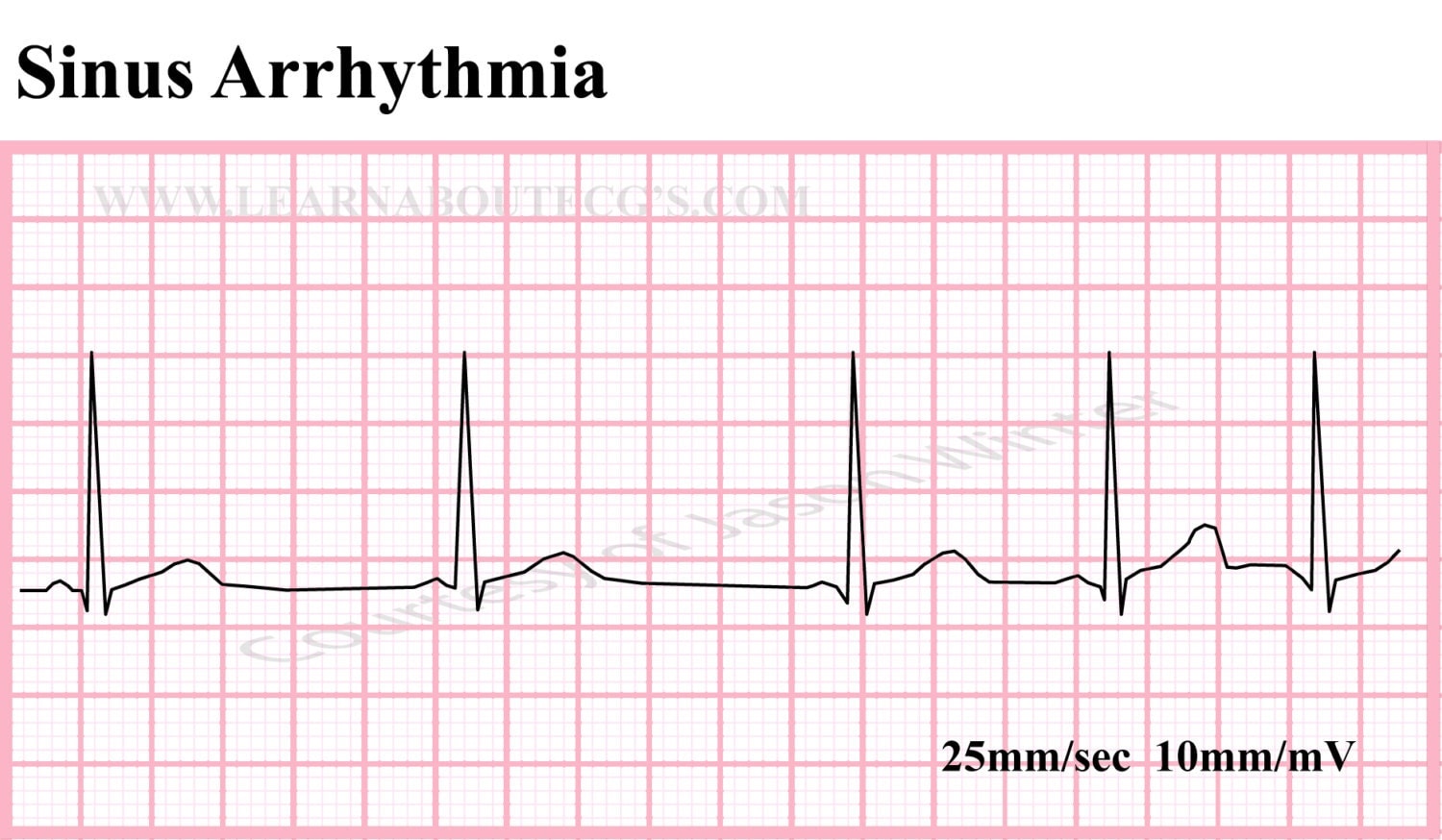 Sinus Arrhythmia Strip by ELECTROCARDIOLOGY on Etsy