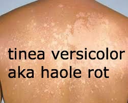 Tinea Versicolor treatment Natural Tinea Versicolor Remedy