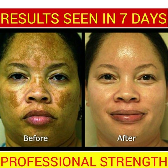 Strong+Dark+Spot+Cream DARK SPOTS &amp; ACNE Scars Strong Bleach Cream 