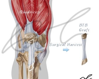 Bone patellar bone graft for ACL surgery - Printable Download, ACL reconstruction, ACL surgery, Btb graft, Human anatomy, Sports medicine