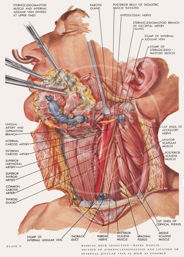 Plate 5 Radical Neck Dissection 10x14 Gicl e Canvas Print