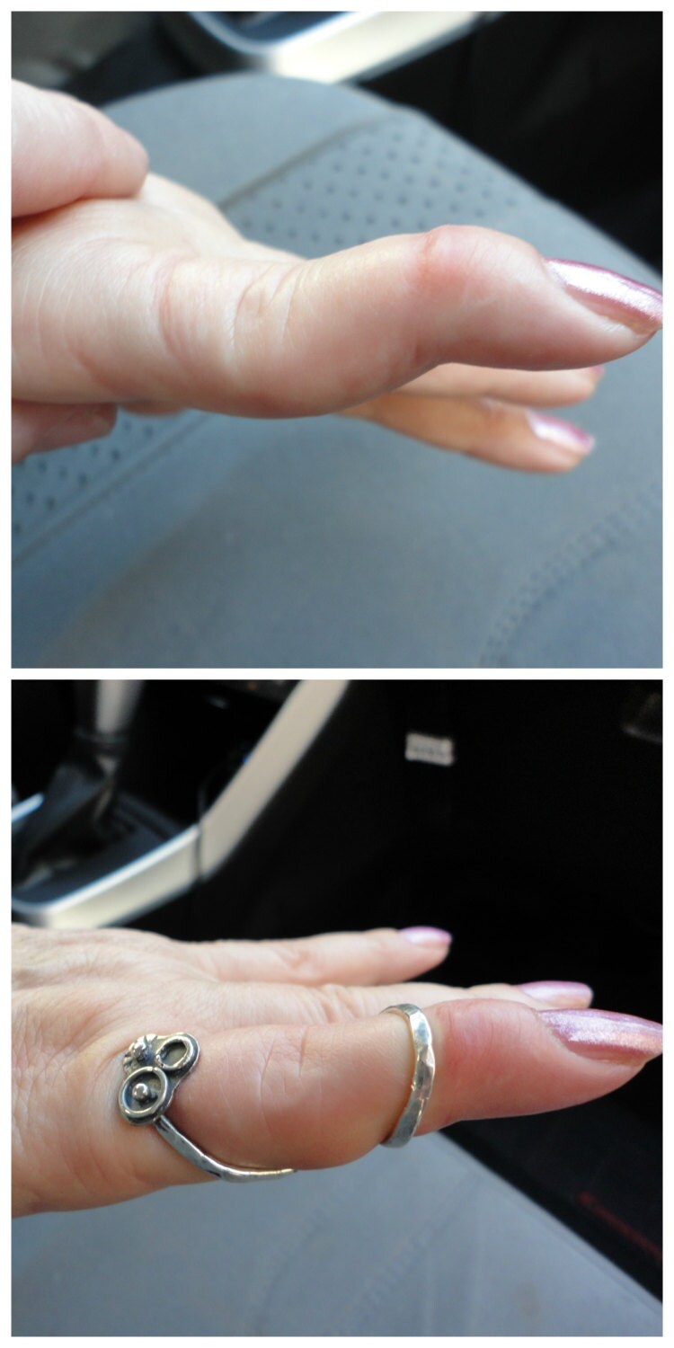 EDS Arthritis Swan Neck Mallet Finger Boutonnire by JewelSplint