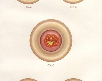 1898 cervix print - Anatomy, uterus, female reproductive system, womb diseases medical wall decor - 119 yr old victorian illustration (C465)
