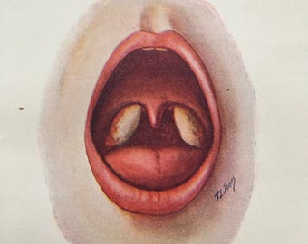Tonsillitis diphtheria 1940s vintage medical illustration
