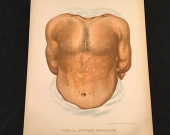 Ringworm of the Chest - Antique Skin Disease Print, Large 1889 Color Lithograph, Taylor's Atlas of Skin Diseases